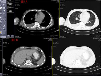 Case Report: Long-term remission of malignant pleural and peritoneal effusion in a case of advanced lung adenocarcinoma treated with combined crizotinib and anlotinib therapy